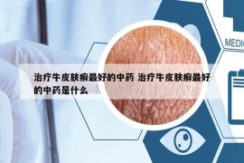 治疗牛皮肤癣最好的中药 治疗牛皮肤癣最好的中药是什么