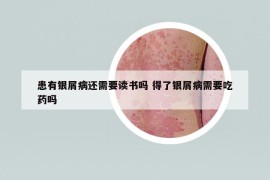 患有银屑病还需要读书吗 得了银屑病需要吃药吗