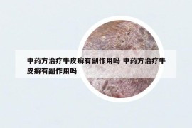 中药方治疗牛皮癣有副作用吗 中药方治疗牛皮癣有副作用吗