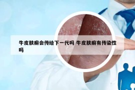牛皮肤癣会传给下一代吗 牛皮肤癣有传染性吗