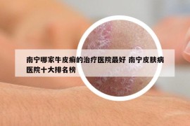 南宁哪家牛皮癣的治疗医院最好 南宁皮肤病医院十大排名榜