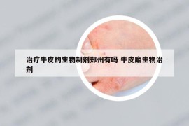 治疗牛皮的生物制剂郑州有吗 牛皮廨生物治剂