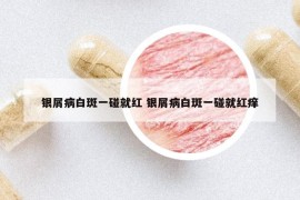银屑病白斑一碰就红 银屑病白斑一碰就红痒