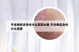 牛皮癣应该多吃什么蔬菜水果 牛皮癣适合吃什么蔬菜