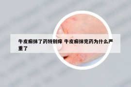 牛皮癣抹了药特别痒 牛皮癣抹完药为什么严重了