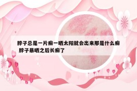 脖子总是一片癣一晒太阳就会出来那是什么癣 脖子暴晒之后长癣了