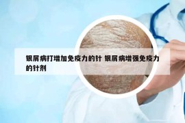 银屑病打增加免疫力的针 银屑病增强免疫力的针剂