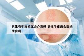 男生有牛皮癣你会介意吗 男性牛皮癣会影响生育吗