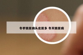 冬季银屑病头皮屑多 冬天银屑病