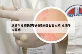 点滴牛皮癣快好的时候疙瘩会变大吗 点滴牛皮肤癣