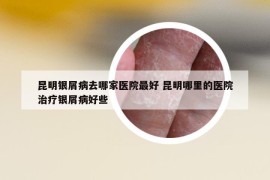 昆明银屑病去哪家医院最好 昆明哪里的医院治疗银屑病好些