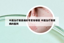 中国治疗银屑病的专家有哪些 中国治疗银屑病的医院