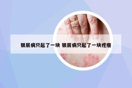 银屑病只起了一块 银屑病只起了一块疙瘩