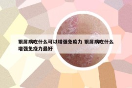 银屑病吃什么可以增强免疫力 银屑病吃什么增强免疫力最好