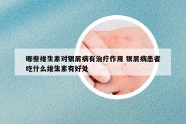 哪些维生素对银屑病有治疗作用 银屑病患者吃什么维生素有好处
