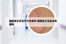 醋酸氯已定治疗牛皮癣吗 醋酸氯已定能杀真菌吗