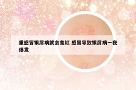 重感冒银屑病就会变红 感冒导致银屑病一夜爆发