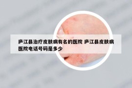庐江县治疗皮肤病有名的医院 庐江县皮肤病医院电话号码是多少