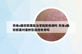 异维a酸软胶囊能治掌跖脓疱病吗 异维a酸软胶囊对囊肿型痤疮有用吗