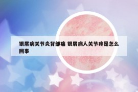 银屑病关节炎背部痛 银屑病人关节疼是怎么回事