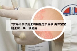 2岁半小孩子腿上有癣是怎么回事 两岁宝宝腿上有一块一块的藓