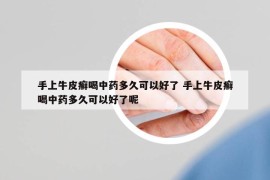 手上牛皮癣喝中药多久可以好了 手上牛皮癣喝中药多久可以好了呢