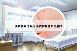 头皮藓用什么药 头皮藓用什么药最好