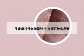 牛皮癣打什么激素针 牛皮癣打什么点滴