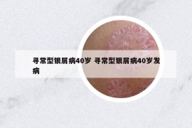 寻常型银屑病40岁 寻常型银屑病40岁发病