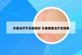 长春治疗牛皮癣较好 长春哪里治疗皮肤癣