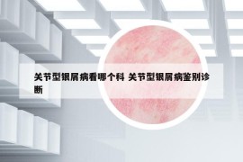 关节型银屑病看哪个科 关节型银屑病鉴别诊断