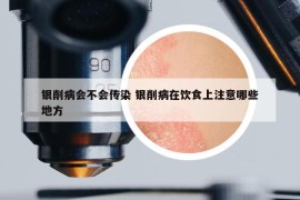 银削病会不会传染 银削病在饮食上注意哪些地方