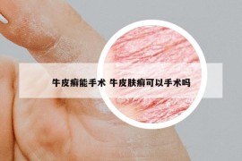 牛皮癣能手术 牛皮肤癣可以手术吗
