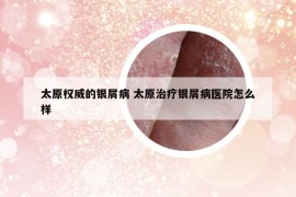 太原权威的银屑病 太原治疗银屑病医院怎么样