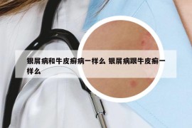 银屑病和牛皮癣病一样么 银屑病跟牛皮癣一样么