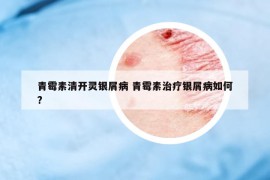 青霉素清开灵银屑病 青霉素治疗银屑病如何?