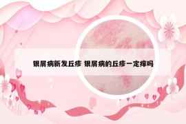 银屑病新发丘疹 银屑病的丘疹一定痒吗