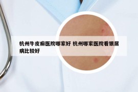 杭州牛皮癣医院哪家好 杭州哪家医院看银屑病比较好