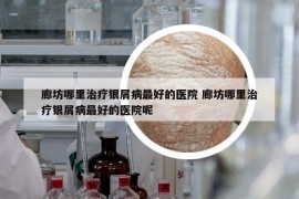 廊坊哪里治疗银屑病最好的医院 廊坊哪里治疗银屑病最好的医院呢