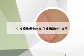 牛皮癣患者少吃肉 牛皮癣能吃牛肉不