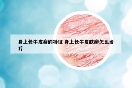 身上长牛皮癣的特征 身上长牛皮肤癣怎么治疗