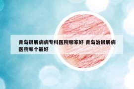青岛银屑病病专科医院哪家好 青岛治银屑病医院哪个最好