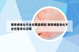 银屑病角化不全主要是原因 银屑病是角化不全还是角化过度