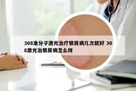 308准分子激光治疗银屑病几次就好 308激光治银屑病怎么样