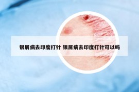 银屑病去印度打针 银屑病去印度打针可以吗