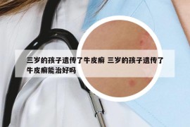 三岁的孩子遗传了牛皮癣 三岁的孩子遗传了牛皮癣能治好吗