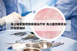 海口哪家医院银屑病治疗好 海口医院哪家治疗皮肤病好