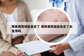银屑病发烧后自愈了 银屑病发烧后自愈了会复发吗