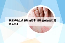 银屑病晚上皮肤红的厉害 银屑病皮肤变红是怎么回事