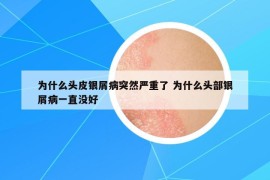 为什么头皮银屑病突然严重了 为什么头部银屑病一直没好